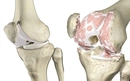 Diz Kapağı Ameliyatı Riskleri ve Sonrası