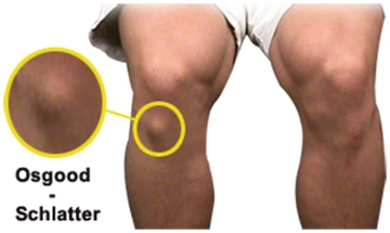 Diz Altı Ağrısı Belirtileri ve Tedavisi