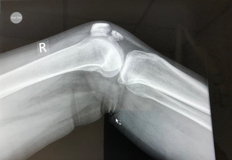 Dizkapağı Çatlağında Aksama Olur mu?